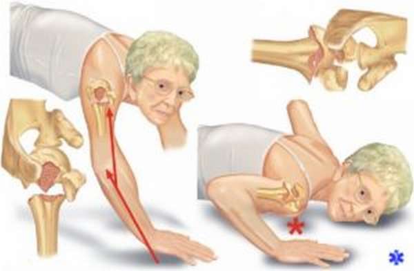 Переломы анатомической шейки плечевой кости происходят в пожилом возрасте при падении